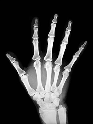 Рентгенограмма кисти руки